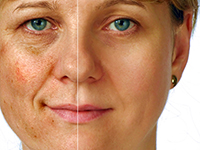 диспорт, ботокс, botox, disport, инъекции, морщины