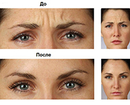 диспорт, ботокс, botox, disport, инъекции, морщины