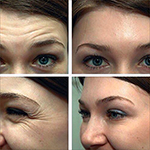 диспорт, ботокс, botox, disport, инъекции, морщины