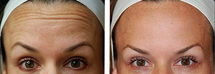 диспорт, ботокс, botox, disport, инъекции, морщины