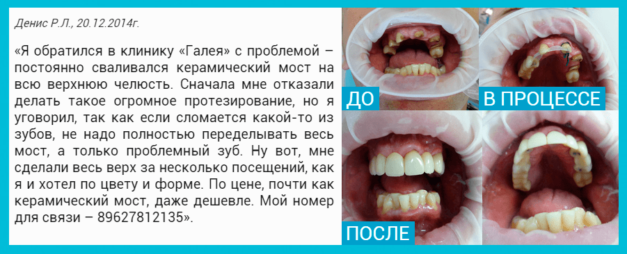 Какие зубы самые крепкие Какие зубы самые крепкие