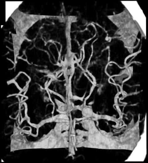 трехмерный медицинский снимок аневризмы головного мозга без бифокальных искажений